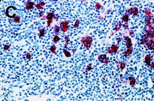 Fig. 2. Labeling of Reed-Sternberg cells with anti–MAGE-A4 MAb 57B in nodular sclerosing lymph nodes. / Patients include HD3 (A and B) and HD4 (C) at low (A), high (B) and intermediate (C) magnification. (B) and (C) correspond to MAGE-A4expression in HD3. Formalin-fixed sections were deparaffinized, heated in a citrate buffer, and incubated with MAb 57B. The antibody was detected with biotinylated secondary antibodies and avidin-coupled alkaline phosphatase. The chromogenic substrate was New Fuschin, and hematoxylin was used to counterstain the tissue.