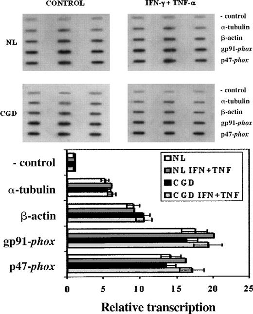 Fig. 2. Transcription rates of genes encoding gp91-phox, and p47-phox in CGD patient's and normal B-cell lines. / Upper panel: Representative nuclear run-on assay showing transcription rates of genes encoding gp91-phox (CYBB), and p47-phox (NCF1) in CGD and normal B cell lines. Lower panel: Graph representing compiled data from 3 experiments; columns indicate means and error bars show SDs. EBV-transformed B cells were cultured under control conditions or with IFN-γ (100 U/mL) and TNF-α (1000 U/mL) for 7 days. The negative control lanes contain pBluescript plasmid alone. Genes encoding α-tubulin and β-actin were included as transcriptionally constitutive controls.