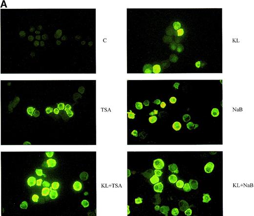 Fig. 5. Minibulk HPC erythroid cultures. / (A) F cells from minibulk HPC erythroid cultures supplemented or not with KL (100 ng/mL) ± TSA (10 ng/mL) ± NaB (0.5 mmol/L). F cells were evaluated by indirect immunofluorescence using an antihuman HbF mAb as a primary antibody and an FITC-conjugated goat antimouse IgG as a secondary antibody. Original magnification × 630. Representative results are shown. (B) Globin chain HPLC scans from mature erythroblasts obtained in minibulk HPC erythroid cultures supplemented or not with KL, TSA, NaB, or combinations thereof (representative results).