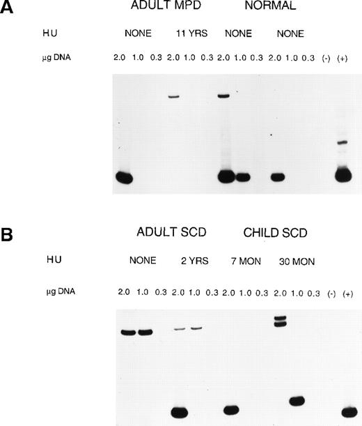 Fig. 2. VDJ recombination events in patients with in vivo hydroxyurea exposure. / A 2-step nested PCR protocol amplifies rare recombination events between TCRγ variable and TCRβ junctional genes on chromosome 7. Dilutions of PBMC DNA ranging from 2.0 to 0.3 μg are listed for each sample. (A) Results for 2 patients with MPD and 2 normal controls. There are positive bands at 2.0 μg DNA for all 4 samples and at 1.0 μg DNA for 1 control. (B) Results for 4 patients with SCD, including 2 adults and serial samples from a child. The gel shows bands at 2.0 and 1.0 μg DNA for both adult patients. The child had a positive signal at 2.0 μg DNA after short-term HU therapy (7 months), but 2 years later had bands at 2.0 and 1.0 μg DNA. (−) is a negative control and (+) is a positive control.