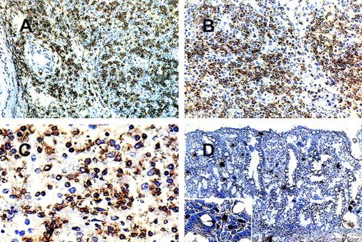 Fig. 1. Results of immunostaining for the NKRs in extranodal lymphomas. / (A) (B) Nasal NK cell lymphoma (case 2): nasal biopsy. Most pleomorphic small-to- medium-sized cells are (A) CD94+ and (B) p140+. (C) Hepatosplenic γ/δ T-cell lymphoma (case 5): splenectomy specimen. Most of the medium-sized and large transformed cells are p58.2+. (D) Preserved intestinal mucosa adjacent to a lymphomatous infiltrate. Scattered lamina propria lymphocytes are p50.3+.