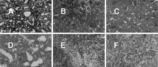 Fig. 1. Live and spleen at day 38 after transplantation. / The liver of untreated, age-matched MPS VII mice (A) showed lysosomal distention in Kupffer cells and a small amount of storage in hepatocytes. At day 38 after transplantation of normal macrophages (B), Kupffer cell storage was markedly reduced. However, reduction of storage in hepatocytes was less marked. The untreated MPS VII mouse spleen showed abundant lysosomal storage in sinus-lining cells in the red pulp (D). At day 38 after transplantation of normal macrophages, there was a similar marked reduction in the amount of lysosomal storage (E). Thirty-eight days after transplantation of genetically modified macrophages, histologic findings in the liver and spleen were similar to those of mice that received normal macrophages (C and F) (A-F, toluidine blue; original magnification × 200).