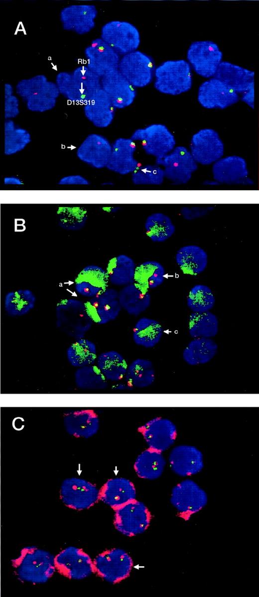 Detection of genetic markers by FISH in different cell populations of patients with B-CLL. / (A) CD34−/AC133− cells displaying (a) heterozygous deletions of both Rb1 and D13S319, (b) heterozygous deletion of Rb1 and homozygous of D13S319, and (c) heterozygous deletion of only Rb1. Red dots (signals) correspond to the Rb1 gene and green ones to the D13S319 locus. Yellow signals are produced by the fusion of red and green signals from Rb1 and D13S319 lying close on the same chromosome (13q14). (B) CD34+/AC133−cells (green surface staining) with different genetic profile: (a) with presence of 2 red and 2 green signals (no deletions), (b) with heterozygous deletion of D13S319, and (c) with heterozygous deletion of both Rb1 and D13S319. (C) CD34+/AC133+ cells (red surface staining) with no marker deletions (all 4 signals present).