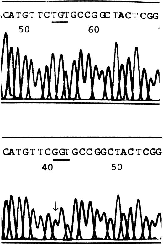 Fig. 1. The partial sequences of FVII from a healthy subject and the patient. / Healthy subject, A; patient, B. The arrow indicates a homozygous T → G transition at the first position of codon 329. This missense mutation results in replacement of cysteine by glycine.