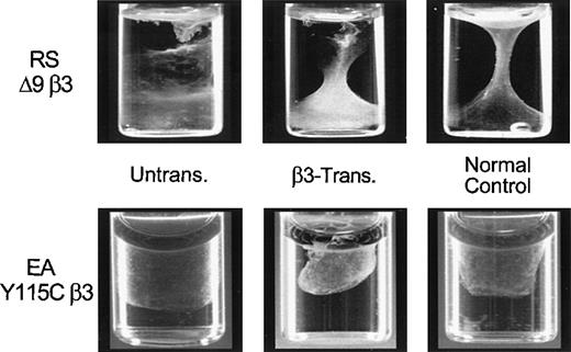 Fig. 5. Fibrin clot retraction assay following −889PlA2β3 transduction of thrombasthenic CD34+ cells. / The RSΔ9β3 and EAY115Cβ3CD34+ cells were transduced with −889PlA2β3, induced for 10 to 14 days to form megakaryocytes in vitro, and then examined for the ability to retract a fibrin clot. Cells (1.5 × 106/mL) were resuspended in IMDM containing 60 μg/mL human fibrinogen in a standard aggregometry tube. Clot formation was initiated by the addition of 2.5 U/mL thrombin. Tubes were incubated at 37°C for up to 12 hours and photographed. The β3-transduced cells were able to mediate clot retraction in vitro similar to the nonthrombasthenic cells (normal control), whereas untransduced patient samples were not able to retract a fibrin clot. A normal control was included for the time each patient sample was assayed.