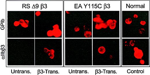 Fig. 2. Indirect immunofluorescence analysis of thrombasthenic CD34+ cells transduced with −889PlA2β3. / The RSΔ9β3 and EAY115Cβ3CD34+ cells were transduced with −889PlA2β3, induced to form megakaryocytes ex vivo, and then examined by indirect immunofluorescence analysis for αIIbβ3surface expression. Cells were blocked in 2% BSA, and incubated with 5 μg monoclonal antibody 6D1 that recognizes megakaryocyte-specific glycoprotein (GP)Ib (top panels) or 5 μg AP2, which recognizes αIIbβ3 (bottom panels), and detected with a PE-conjugated F(ab′)2 donkey antimouse secondary antibody. Five to 10 days after transduction, megakaryocytes were present in untransduced and β3-transduced cell cultures as demonstrated with the anti-GPIb antibody; however, only β3-transduced cells demonstrated detectable αIIbβ3 complex on the surface of derived megakaryocytes similar to cultured megakaryocytes from a normal individual (control). There are at least 3 cells in each field of untransduced thrombasthenic cells stained with AP2 for αIIbβ3.