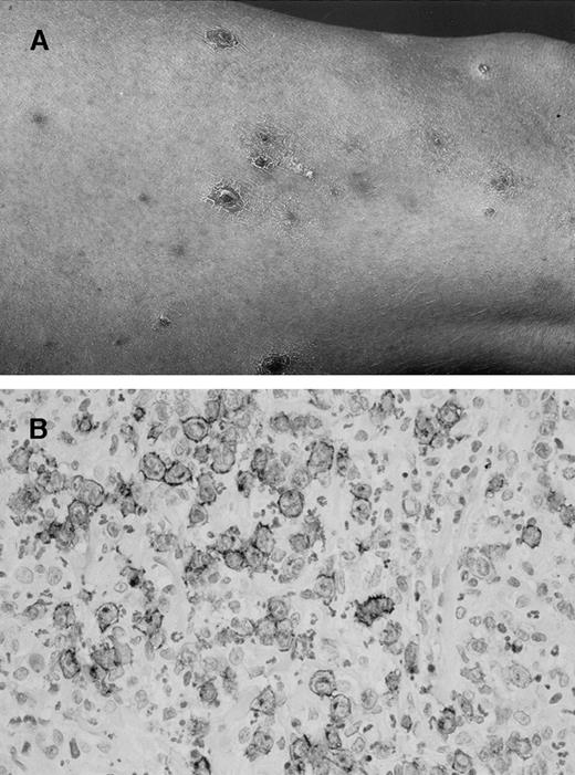 Fig. 1. Lymphomatoid papulosis. / (A) Characteristic papular and papulonecrotic lesions at different stages of evolution. (B) Mixed inflammatory infiltrate with scattered CD30+ blast cells.