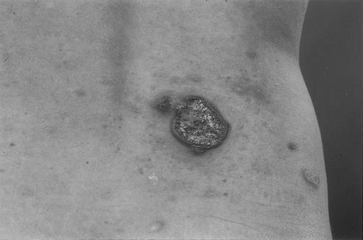 Fig. 2. A large ulcerating tumor (diameter, 5 cm) developed in a 12-year-old boy with lymphomatoid papulosis. / The tumor disappeared spontaneously within 2 months.