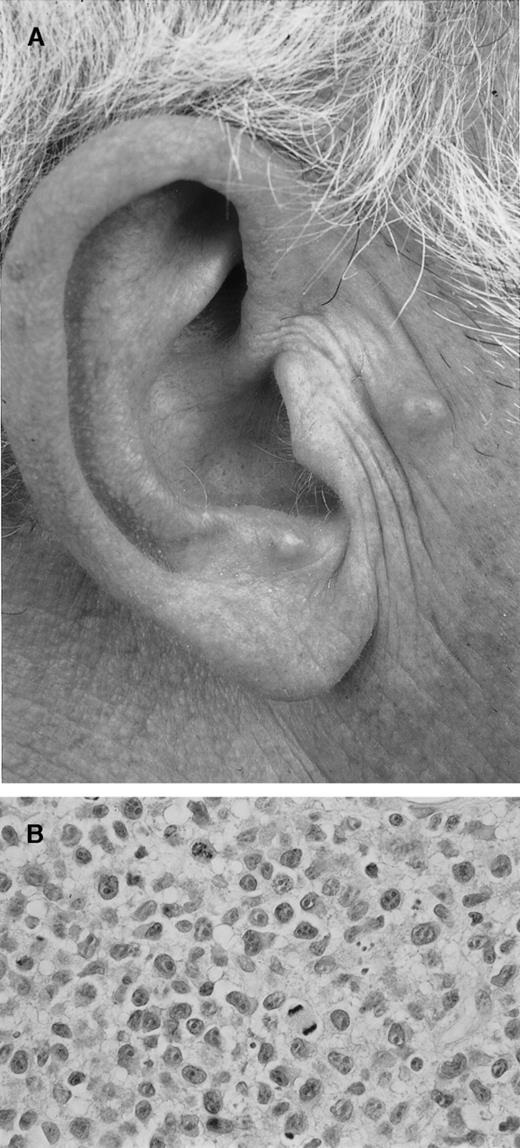 Fig. 3. Lymphomatoid papulosis (type C). / (A) Approximately 10 firm papules on the face and the chest. (B) Detail of dermal infiltrate showing a monotonous population of large anaplastic (CD30+) cells. During follow-up there was complete spontaneous resolution of all skin lesions, whereas new lesions continued to develop.
