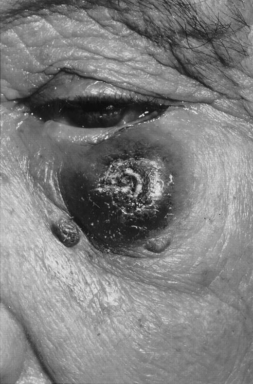 Fig. 4. Primary cutaneous CD30+ large T-cell lymphoma with 1 large, partly ulcerating tumor.