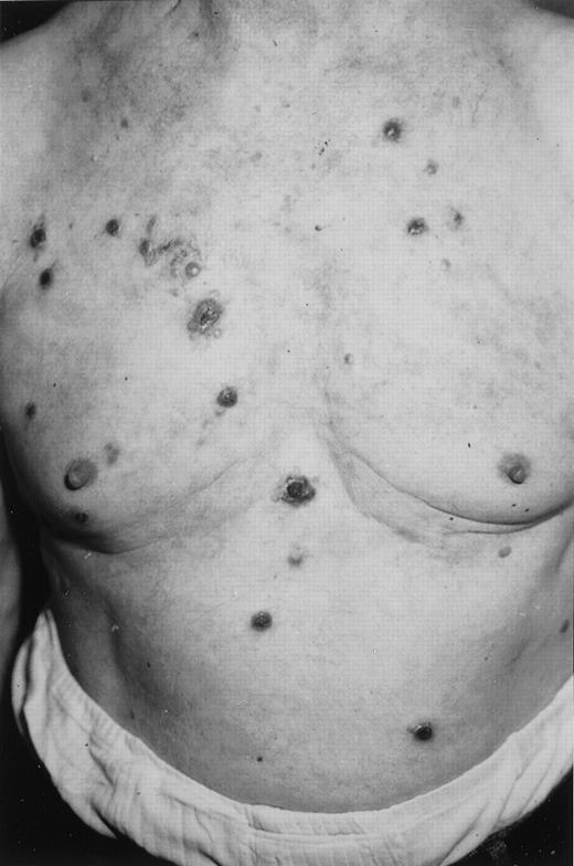 Fig. 5. Primary cutaneous CD30+ large T-cell lymphoma with multifocal persistent skin lesions. / There was no spontaneous remission of any of these lesions.