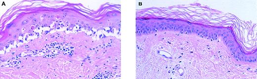 Fig. 7. Skin biopsy specimens. / Skin biopsies were obtained from patient 2 just before (A) and 2 weeks after (B) treatment with the IT combination. The appearance of the skin before treatment is typical for severe GVHD. A scattered infiltration of lymphocytes can be observed, localized primarily around the blood vessels and the junctional region of dermis (lower side) and epidermis (upper side). The epidermal basal layer is destroyed and the epidermis is disrupted from the basal lamina. Following treatment, no remaining signs of lymphocyte infiltrations were detectable. The basal layer had regained its natural well-organized configuration (original magnification × 100, hematoxylin-eosin).