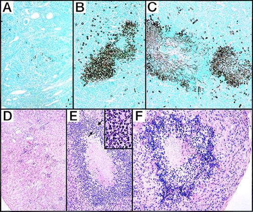 Fig. 10. Tissue sections were prepared from kidneys of wild-type, G-CSF−/−, and G-CSF−/−/GM-CSF−/− mice 7 days after infection with C albicans. / Sections were stained with Gomori methenamine silver stain (top panel) and haematoxylin-eosin stain (bottom panel). (A, D) Wild-type mice show healing inflammatory lesions in the cortex and few yeast cells. (B-C, E-F) G-CSF–deficient and G-CSF/GM-CSF-deficient mice, respectively, show numerous abscesses throughout the section with large aggregates of fungal yeasts within abscesses. Inset shows polymorphonuclear neutrophils in an area of dense leukocytic infiltration surrounding fungal yeasts (marked by arrows).