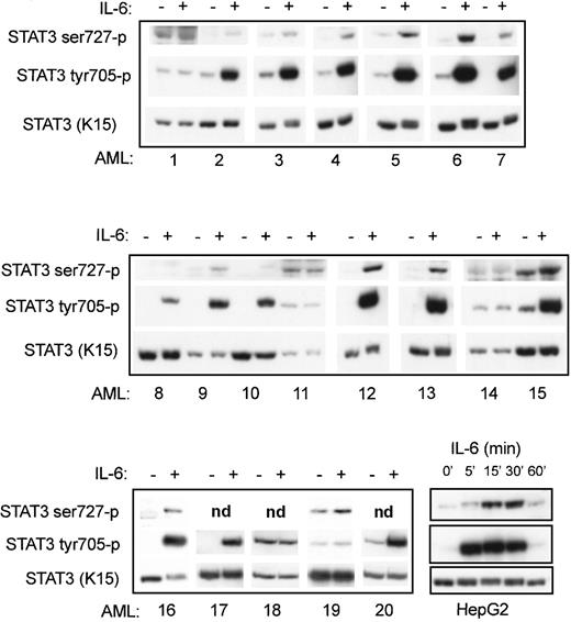 Fig. 1. Constitutive and non-IL-6–inducible Stat3 phosphorylation patterns are observed in 25% of the investigated patients with AML. / AML cells and HepG2 cells were plated in 12-well culture plates, either unstimulated or stimulated with 10 ng/mL IL-6 for 15 minutes (AML) or for 5 to 60 minutes (HepG2), and equal amounts of total cell lysates were subjected to SDS–PAGE followed by Western blot analysis. Phosphorylated Stat3 was visualized using phospho-specific antibodies recognizing Tyr705- and Ser727-phosphorylated Stat3. As a control, equal amounts of total cell lysates were Western blotted using antibodies against Stat3 (K-15).