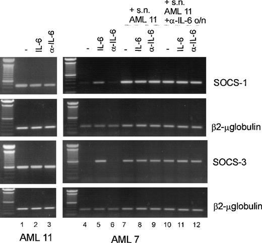 Fig. 4. High lL-6 secretion levels correlate with high SOCS1 and SOCS3 expression levels. / AML cells (patients 11, 7) were cultured in 12-well plates and stimulated for 1 hour with IL-6 (lanes 2, 5, 8, 11) or with anti-IL-6 for 2 hours (lanes 3, 6, 9, 12). In lanes 1 to 6, cells were cultured in RPMI 1640 for 24 hours before stimulation. In lanes 7 to 9, cells from patient 7 were cultured in the AML supernatant from patient 11. In lanes 10 to 12, cells from patient 7 were cultured in the AML supernatant from patient 11, which was depleted of IL-6 by adding anti-IL-6. Total RNA was isolated, 3 μg RNA was reverse transcribed with M–MuLV reverse transcriptase, and cDNA was used in a PCR reaction using specific primers for SOCS-1, SOCS-3 or β2-μglobulin as a control.