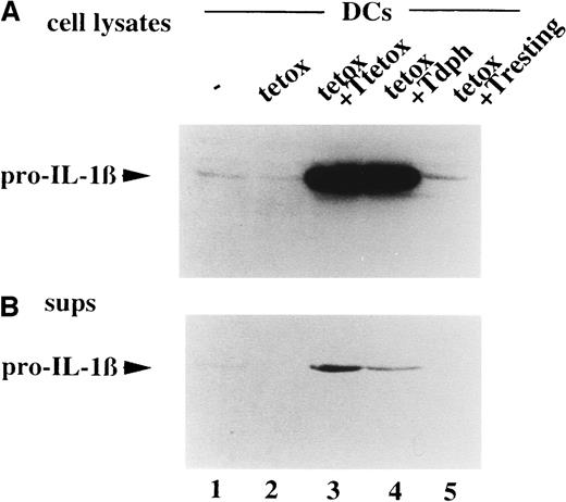 Fig. 2. Activated T cells induce synthesis of pro–IL-1β without secretion. / (A, B) DCs untreated (−, lane 1) or loaded with tetox for 16 hours (lanes 2 to 5) were incubated 8 hours alone (lanes 1 and 2) or in the presence of autologous antitetox T lymphocytes (+Ttetox, lane 3) or autologous antidermatophagoides T lymphocytes (+Tdph, lane 4) or with autologous resting T cells (+Tresting, lane 5) at a T-cell:DC ratio of 10:1. At the end of the incubation, cell lysates (A) and supernatants (B) were analyzed for their content in IL-1β by Western blotting. (C-E) Autologous specific (antitetox; ○) or aspecific (anti-dph; ▪) T lymphocytes were coincubated with tetox-loaded DCs for 8 hours at T-cell:DC ratios varying from 0.5:1 to 10:1. DC intracellular pro–IL-1β was analyzed by Western blotting and quantitated by densitometry.