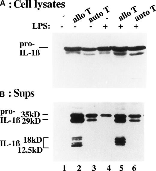 Fig. 3. Challenge of DCs with alloreactive, but not with nonspecific T lymphocytes, results in secretion of processed, bioactive IL-1β. / (A, B) DCs, untreated (lanes 1 to 3) or treated with LPS for the last 40 hours (lanes 4 to 6) were challenged with activated allospecific T lymphocytes (allo T, lanes 2 and 5) or autologous activated T lymphocytes (auto T, lanes 3 and 6) at a T-cell:DC ratio of 10:1. Cell lysates (panel A) and supernatants (sups, panel B) were analyzed as for their content in pro–IL-1β or IL-1β by Western blot. (C) Bioactivity of secreted IL-1β: 100 μL aliquots of supernatants from the different culture conditions was added to HUVEC and incubated at 37°C for 20 hours. At the end of the incubation, the ICAM1 molecules expressed by HUVEC were quantified by ELISA.