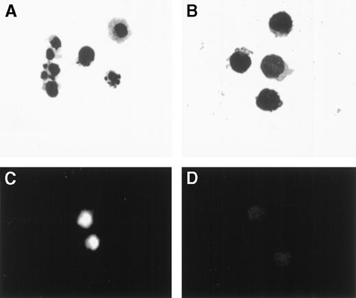 Fig. 3. Wright-Giemsa stain and TUNEL assay of PBMCs obtained from a patient 21 days following transplantation, incubated for 24 hours, and separated by sorting into CD3+/7AAD+and CD3+/7AAD− cells. / (A) Cells in the CD3+/7AAD+ fraction showed reduction in cell volume, blebbing of plasma membrane, chromatin condensation, and nuclear fragmentation (original magnification × 1000), (B) while cells in the CD3+/7AAD− fraction showed a typical morphological feature of lymphocytes. (C) Cells in the CD3+/7AAD+ fraction were brightly fluorescent, indicating incorporation of fluorescein-dUTP into fragmented DNA (original magnification × 400), (D) while cells in the CD3+/7AAD− fraction showed no significant fluorescence.
