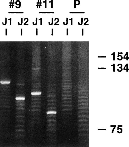 Fig. 1. PCR clonality analysis. / CDR3-related PCR products were obtained by amplifying lymphoma biopsy DNA with consensus FW3 and JH1 primers. Small aliquots of the resultant products were also secondarily amplified with FW3 and more internal JH2 primer. Shown are products from both FW3-JH1 and FW3-JH2 reactions for 2 cases and a polyclonal control after electrophoresis in an 8% acrylamide gel and staining with ethidium bromide. Prominent single monoclonal bands are seen in each case, along with fainter polyclonal ladders that reflect background B cells with different sized CDR3s that are also invariably present. The smaller sizes of the FW3-JH2 generated monoclonal bands simply reflect the more 5′ location of JH2 relative to JH1. Secondary amplifications with JH2 were performed to potentially enhance weaker monoclonal signals relative to the polyclonal background and to determine whether the JH2 primer would work with the clonalVH gene in PCR reactions to obtained more full length VH products.