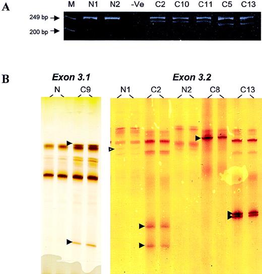 Fig. 1. PCR and PCR–SSCP analyses. / (A) Analysis of PCR products of BCL10 exon 3.2 on polyacrylamide gels. M, marker; N, normal DNA samples; −Ve, negative control. Patients C2, C10, and C11 showed a novel PCR product corresponding to a 17-bp deletion, whereas patients C5 and C13 showed a novel PCR band corresponding to a 28-bp deletion. (B) PCR–SSCP analysis of BCL10 exon 3.1 (left panel) and exon 3.2 (right panel). N, normal DNA samples; C, DNA samples from patients with lymphoma. Open arrowhead indicates a G > A polymorphism in codon 213. Filled arrowhead highlights abnormal migrating SSCP bands.