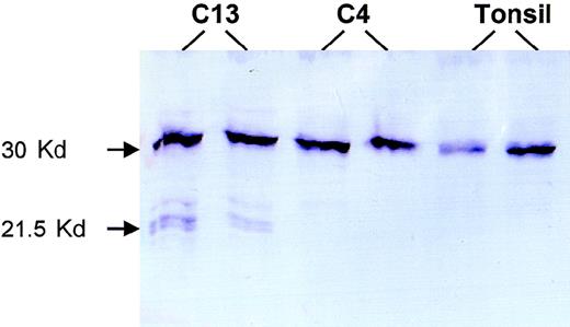 Fig. 4. Western blot analysis. / Patient C13 had a 28-bp deletion between codons 170 and 179 that caused a truncated BCL10 of 169 amino acids. Western blot analysis of this case shows 3 truncated forms of BCL10. The biochemical differences of these various forms are unclear, nor is it clear why the amount of the truncated protein is much less than that of the full-length BCL10 despite the prevalence of tumor cells in the fresh tissue examined. Patient C4 had a substitution at the 3′ coding exon 2 splicing site, which led to a truncated BCL10 product of 119 amino acids that was not recognized by the monoclonal antibody 151 (mapping to amino acids 122-168). Both this case and tonsil show only full-length BCL10.