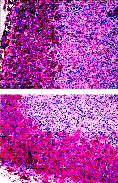 Fig. 1. Immunohistopathology of L540rec tumors in SCID mice. / Lymph node infiltrates visualized by 2A3 (A) and Ber-H2 (B) using the biotin–streptavidin method. Magnification ×200; scale bar, 50 μm.