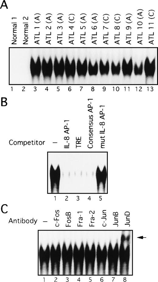 Fig. 4. AP-1 binding activity in nuclear extracts from leukemic cells of patients with ATL involves JunD. / (A) Increased AP-1 binding activity in nuclear extracts of leukemic cells of patients with ATL. A, acute-type; C, chronic type. (B) Specificity of the DNA-protein complex formation at the AP-1 site in competition EMSA. Nuclear extracts from leukemic cells of patient 9 were mixed with the labeled IL-8 promoter containing the AP-1 site, in the absence (lane 1) or presence of 100 ng of IL-8 AP-1 site (lane 2), TRE (lane 3), consensus AP-1 (lane 4), or mutated IL-8 AP-1 site (lane 5) competitors. (C) The AP-1 binding complex was recognized by anti-JunD antibody. Nuclear extracts from leukemic cells of patient 9 were preincubated without or with the antisera indicated on top of each lane, before adding the IL-8 AP-1 site probe to the binding mixtures. A supershift band was observed on addition of antisera against JunD (arrow).