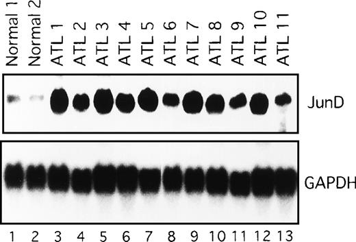 Fig. 5. Expression of JunD mRNA in primary leukemic cells from patients with ATL, by Northern blot analysis. / GAPDH expression served as control. Molecular sizes of the transcripts were as follows. JunD, 1.8 kb; GAPDH, 1.8 kb.