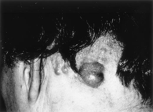 Fig. 2. Cutaneous follicular lymphoma. / Clustered erythematous papules and tumors on the scalp, (patient 14).