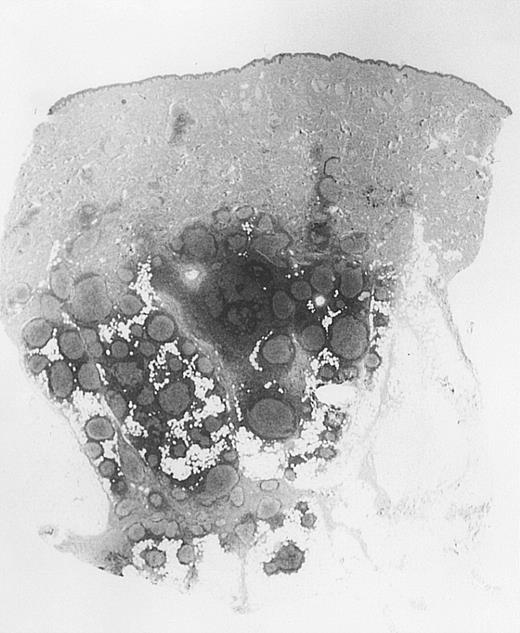 Fig. 3. Bottom-heavy lymphoid infiltrate with prominent follicular pattern. / Located in the deep dermis and subcutaneous tissue (patient 9).