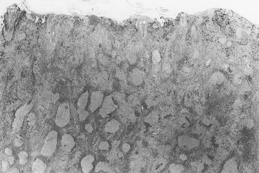 Fig. 4. Dense infiltrate with prominent follicular pattern. / Appears within the entire dermis (patient 5).