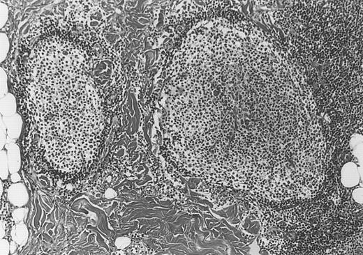 Fig. 5. Neoplastic follicles. / The follicles lack a normal mantle zone and reveal nearly complete absence of tingible body macrophages (patient 9).