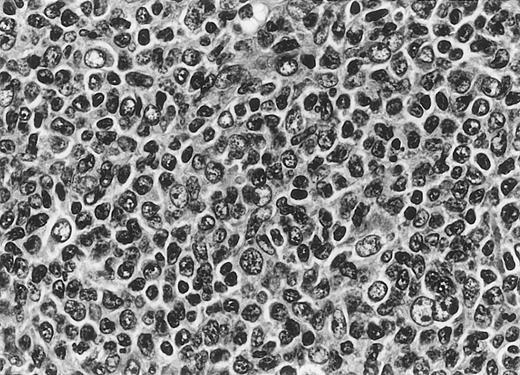 Fig. 6. Cytomorphology. / Centroblasts and centrocytes evident within a follicle (patient 3).