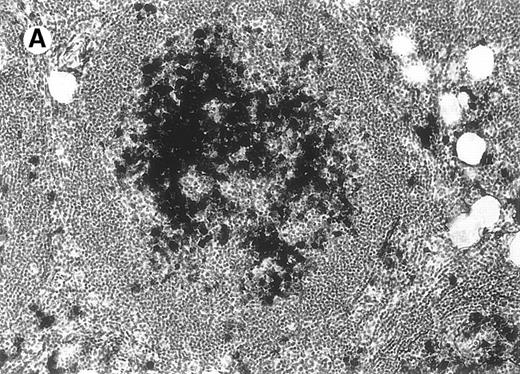 Fig. 7. Immunohistology of neoplastic follicles. / (A) CD10 positivity of follicle center cells; note positivity of scattered cells within interfollicular areas. (B) Decreased reactivity of the follicles for the proliferation-associated antibody MIB-1. (C) Bcl-2 negativity of follicle center cells.