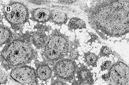 Fig. 7. Immunohistology of neoplastic follicles. / (A) CD10 positivity of follicle center cells; note positivity of scattered cells within interfollicular areas. (B) Decreased reactivity of the follicles for the proliferation-associated antibody MIB-1. (C) Bcl-2 negativity of follicle center cells.