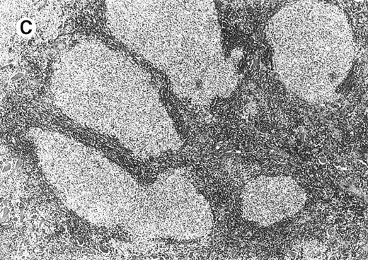 Fig. 7. Immunohistology of neoplastic follicles. / (A) CD10 positivity of follicle center cells; note positivity of scattered cells within interfollicular areas. (B) Decreased reactivity of the follicles for the proliferation-associated antibody MIB-1. (C) Bcl-2 negativity of follicle center cells.