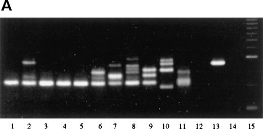 Fig. 8. PCR analysis of microdissected specimens. / (A) Example of a monoclonal pattern of JH gene rearrangement of cells within the follicles after laser-based microdissection in 1 patient with FCL (patient 9). Lanes: 1 to 5, 5 different follicles; 6 to 11, 6 different interfollicular areas; 12, negative control (no DNA, external PCR run); 13, positive control (cutaneous B-cell lymphoma); 14, negative control (no DNA, internal PCR run); 15, molecular ladder. (B) Example of a polyclonal pattern of JH gene rearrangement of follicle center cells and interfollicular cells after laser-based microdissection in 1 patient with FCL (patient 6). Lanes: 1, molecular ladder; 2 to 7, 6 different follicles; 8 to 12, 5 different interfollicular areas; 13, negative control (no DNA, external PCR run); 14, positive control (cutaneous B-cell lymphoma). (C) Marginal zone lymphoma reveals monoclonality of interfollicular cells and polyclonal pattern of reactive germinal centers. Lanes: 1 to 4, reactive germinal centers; 5 to 9, interfollicular areas; 10, molecular ladder. One of the bands in lane 4 may represent follicular colonization by neoplastic marginal zone cells.