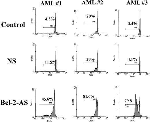 Fig. 6. Flow cytometric determination of apoptosis induced by Bcl-2-AS in primary AML cells. / AML blasts were incubated in the presence of 8 μmol/L of Bcl-2-AS for 5 days as described in “Materials and methods.” Detection of apoptotic cells (cells in the subG1 region) was based on DNA fragmentation.