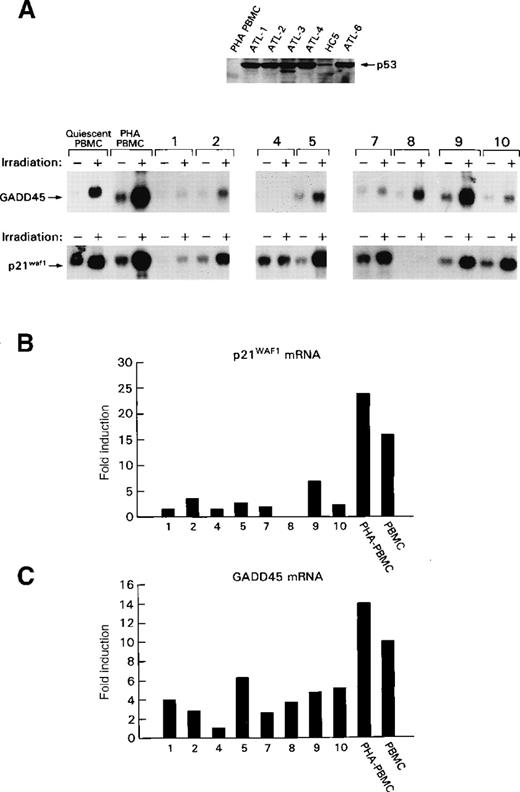 Fig. 2. p53 stabilization and transcriptional impairment in ex vivo ATLL cells. / (A) Top panel: Western blot of total cellular lysates from ATLL cells from patients 1 to 4 and 6 or from HTLV-I carrier (HC 5) or normal human PBMC. Bottom panel: Northern blot analysis of the GADD45 and p21WAF1 expression after ionization–radiation treatment (+) of ATLL cells from patients 1, 2, and 4 and from HC 5.5In patients 7 to 10, protein lysates for p53 analyses were unavailable. The numbers designate the same patients in both top and bottom panels of the figure. (B, C) Quantitative summaries of the data presented in the bottom part of A as fold induction of GADD45 mRNA (B) or p21WAF1 mRNA after ionization–radiation. Results were obtained from a single experiment in each patient because of the intrinsic limitation of cells available.