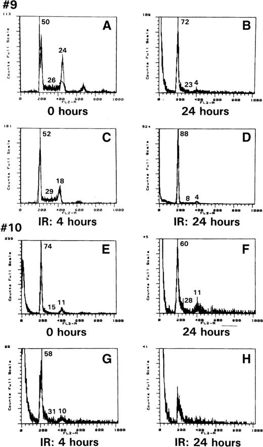 Fig. 3. ATLL cell resistance to ionization–radiation-induced apoptosis. / Propidium iodide staining of cells from patients 9 (A) and 10 (E) after Ficoll purification; after 24 hours in culture (B, F), or 4 or 24 hours after ionizing treatment (C and D for patient 9, G and H for patient 10). The number refers to the percentage of cells in G1, S, or G2/M.