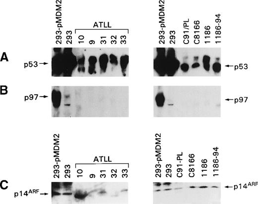Fig. 4. Expression of MDM2, p14ARF, and p53 in ex vivo ATLL cells and HTLV-I–infected cells. / (A) Detection of p53 with the antibody FL-393. (B) Detection of MDM2 with the N-20 antibody. (C) Detection of p14ARF with antibody (C20) that recognizes the p14ARF carboxy terminus.