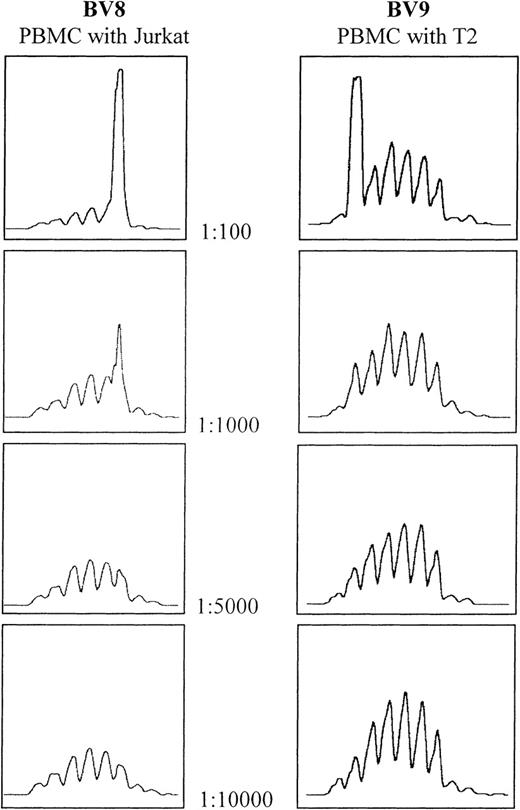 Fig. 1. Determination of spectratype sensitivity to the addition of cells bearing clonally rearranged T-cell–receptor genes. / Serial dilutions of both Jurkat and T2 cell lines were made using PBMCs from the same healthy donor. In both cases, the threshold for detection lies between 1:1000 and 1:5000.