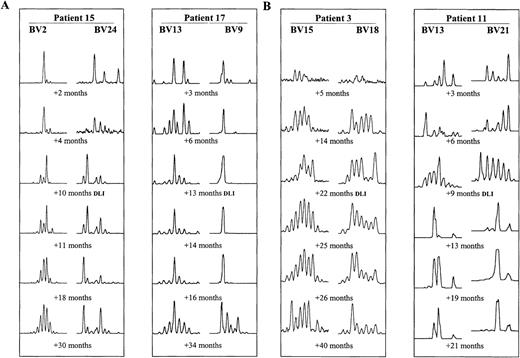 Fig. 2. Examples of CDR3 size pattern evolution after BMT. / Size profiles of 2 different BV subfamilies at 6 time points are shown for each patient. (A) Examples of interpatient and intrapatient variability in patients 15 and 17, who underwent DLIs +13 months and +14 months after BMT, respectively. (B) Examples of spectratype change after DLI. Improving spectratypes in patient 3 (DLI +22 months) and more abnormal spectratypes after DLI in patient 11 (DLI +9 months).