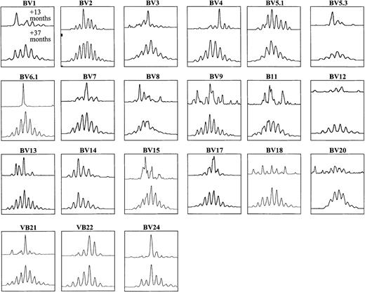 Fig. 3. CDR3 size profiles with 21 subfamily-specific primers at 2 time points after BMT in PBMCs from patient 1. / The patient underwent DLI +23 months after BMT, with subsequent normalization of spectratypes by +37 months after BMT.