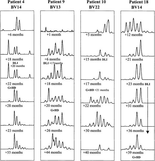Fig. 4. Evolution of CDR3 size profiles in patients 4 (DLI +20 months), 9 (DLI +17 months), 10 (DLI +15 months), and 18 (multiple DLI treatments between +23 and +36 months after BMT), all in whom GVHD developed, as indicated. / Patterns for 1 BV subfamily are shown for each patient at 6 time points after BMT.