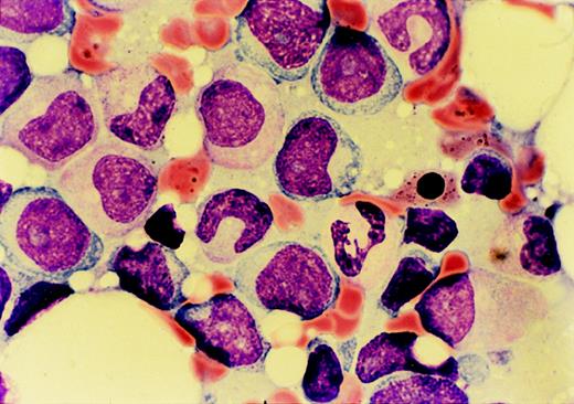 Fig. 1. Marrow aspirate morphology on presentation of case 1 with refractory anemia with excess blasts in transformation. / Dysplastic granulocytic cells, a ringed sideroblast, and numerous myeloblasts are seen.