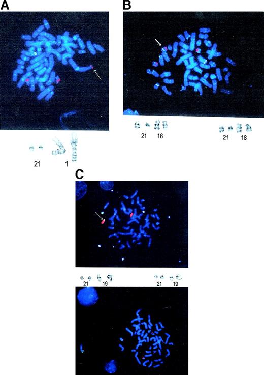 Fig. 2. FISH analysis of the 3 radiation-induced AML cases. / (A) Case 1. The 3 red signals represent the 2 AML1 genes on chromosome 21q22 and the translocation to chromosome 1p36. The green signal represents TEL on chromosome 12, which serves as an internal control for quality of the FISH. An arrow denotes the translocatedAML1 gene. A partial karyotype is below the FISH photomicrograph, showing the reciprocal translocation between chromosomes 1 and 21. (B) Case 2. The 3 red signals represent the 2AML1 alleles on 21q22 and the translocation to chromosome 18q21. Besides the 2 green TEL signals on chromosome 12, chromosome 18 was labeled with a centromeric probe. An arrow denotes the chromosome 18 with the AML1 translocation. A partial karyotype showing the chromosome 18 and 21 translocations is below the photomicrograph. (C) Case 3. The upper photomicrograph shows 3 green signals representing chromosome 21 paint, whereas the red represents chromosome 19 paint. There is extra chromosome 21q material on chromosome 19q13. An arrow denotes the AML1 translocation to chromosome 19. The lower photomicrograph shows the FISH analysis with the TEL-AML1 probe. The 3 red signals indicate the split AML1 gene. A partial karyotype showing the translocation between chromosomes 19 and 21 is also present.