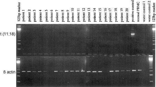 PCR-amplification for the t(11;18) fusion and for β actin (as reference).