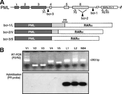 Fig. 1. Schematic representation of PML breaksites and PML-RARα fusion mRNAs. / (A) The 3 PML breakpoint cluster regions (bcr-1, -2, and -3) are indicated by vertical arrowheads, and the resultant L, V, and S PML-RARα isoforms are diagrammed. PML exons are indicated by numbered, shaded rectangles. The positions of primers used to amplify PML-RARα mRNA are indicated below their respective exons. (B) PCR products were electrophoresed and visualized by staining with ethidium bromide and then transferred to nylon membranes and hybridized with junctional probe PR. In L-form APL, as well as in the NB4 cell line, the PML breaksite is in intron 6 (bcr-1), and full-length PML exon 6 is fused in-frame to exon 3 (Ex 3) of RARα. In such cases, primers P2 and R2 generate a 283-bp chimeric PCR product that is detected by hybridization to the junctional oligonucleotide probe, designated PR (lanes L1, L2, NB4). V-form cases, by definition, lack variable amounts of terminal exon 6 sequence and give variable-sized bands with primer set P2/R2 (panel B, lanes V1-V5). In most cases, due to loss of exon 6 sequence, the amplicon is smaller than 283 bp (ie, V2, V3, V5); however, due to insertion of genomic DNA from RARα intron 2, the amplified fragment can be larger (case V1) or essentially the same size (case V4) as the 283-bp L-form fragment. These latter V-form cases are distinguished from L-form cases by lack of hybridization to the PR probe, and/or by sequencing the P2/R2 amplicon.