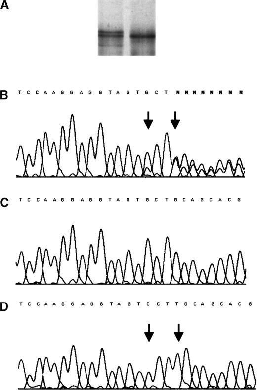 Fig. 1. SSCP analysis and sequencing chromatogram for the mutation insT 1689 after amplification from genomic DNA of the propositus. / (A) SSCP analysis. (B) Sequencing chromatogram for the mutation. The PCR product amplified from the genomic DNA of the propositus was cloned into the pCR® 2.1-TOPO vector (Invitrogen, Leek, The Netherlands). After propagation in E coli, 10 clones containing either of the amplified alleles were sequenced. (C) The normal allele. (D) The mutant allele. Arrows indicate the position of mutations.